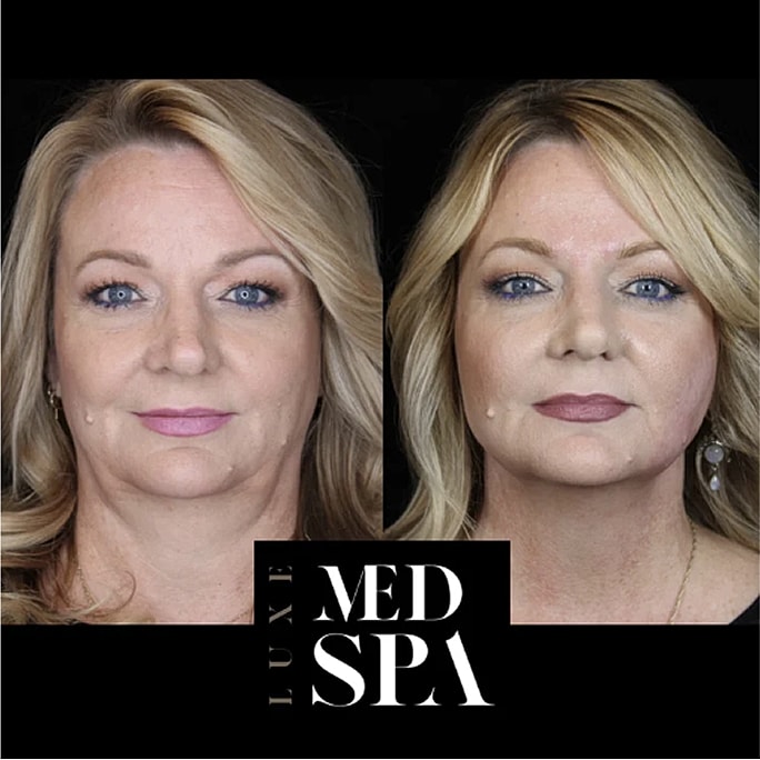Before and after skincare treatment at med spa.